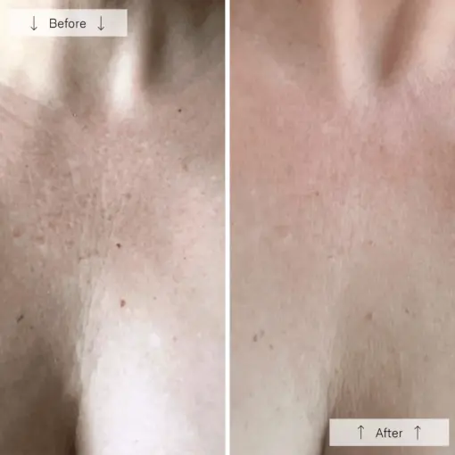 Lanveza LED Neck & Chest Therapy Kit - Image 4
