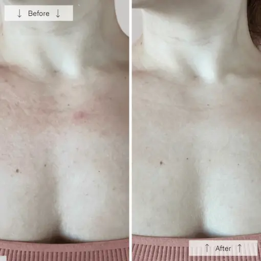 Lanveza LED Neck & Chest Therapy Kit - Image 3